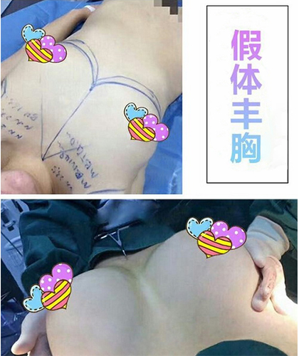 假體豐胸手術效果圖