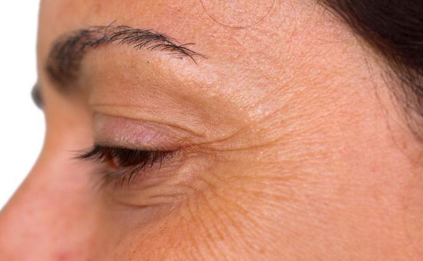 眼角紋怎么消除簡(jiǎn)單方法？眼角紋去除要多少錢？