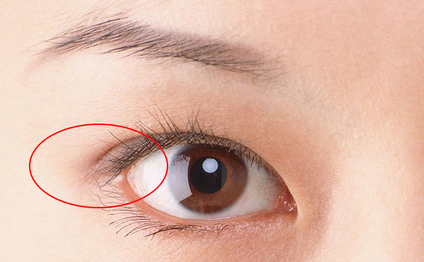 開外眼角價格多少錢?開外眼角術(shù)后怎么護理?