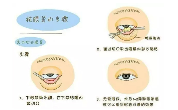 內(nèi)切去眼袋安全性怎么樣?內(nèi)切去眼袋會(huì)復(fù)發(fā)嗎?
