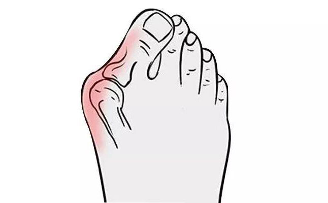 大腳骨矯正手術(shù)多少錢？大腳骨矯正三個(gè)月可以恢復(fù)嗎？