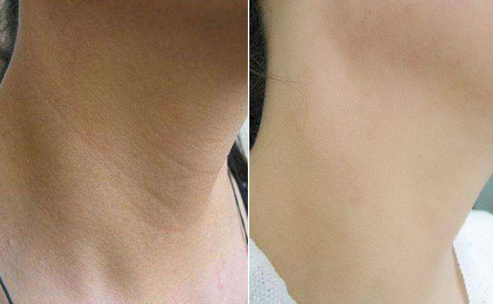 嗨體去頸紋效果怎么樣？