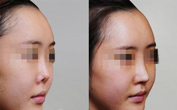 修復(fù)后的鼻翼缺損是否真實(shí)？