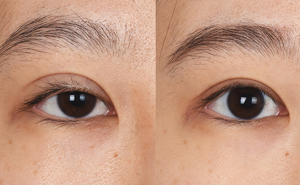 眼部修復風險大嗎？眼修復價格是多少？