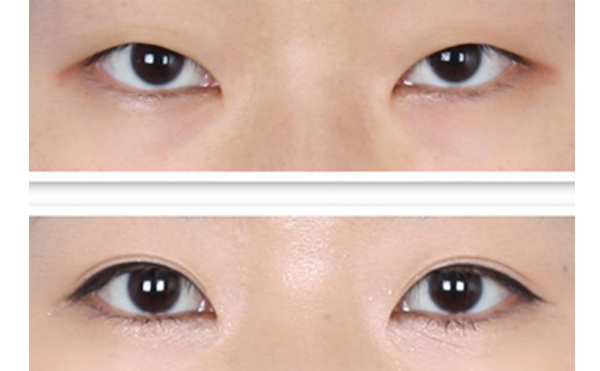 瞼松弛矯正適應(yīng)癥是什么?術(shù)后怎么護(hù)理?