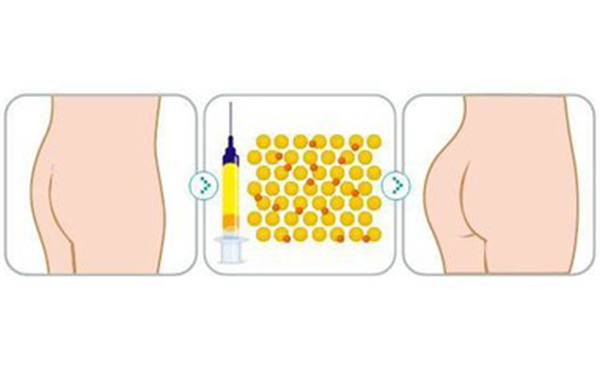 自體脂肪豐臀優(yōu)勢是什么?適合哪些人群?