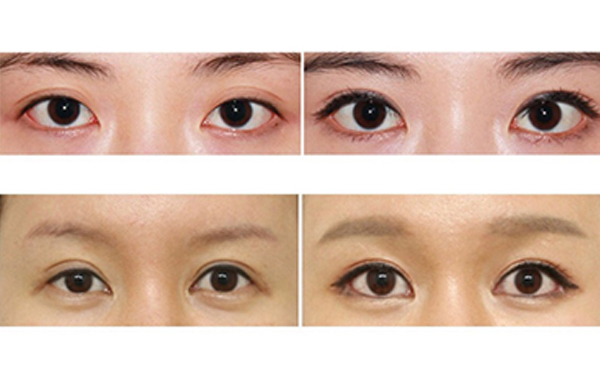 為什么醫(yī)生不建議開外眼角？