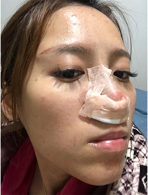 肋軟骨鼻綜合案例：恢復期效果