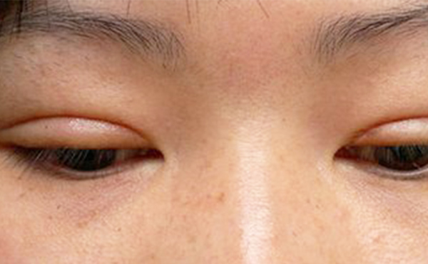埋線雙眼皮失敗該如何修復(fù)？多久修復(fù)好？