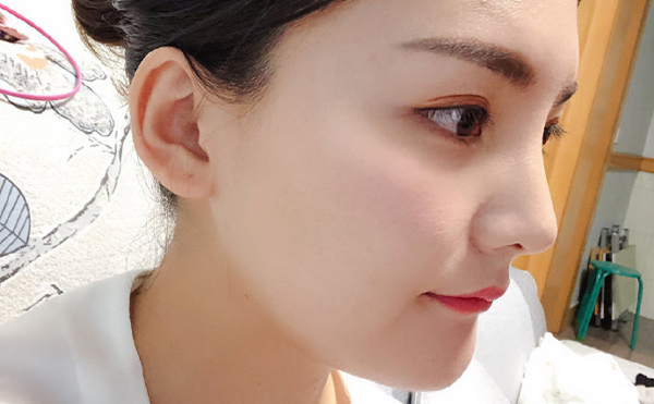 石家莊藍山杜建龍醫(yī)生下頜角整容手術(shù)案例一年