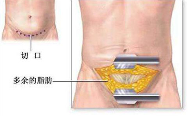 腹壁松弛是什么原因?腹壁松弛怎么辦?