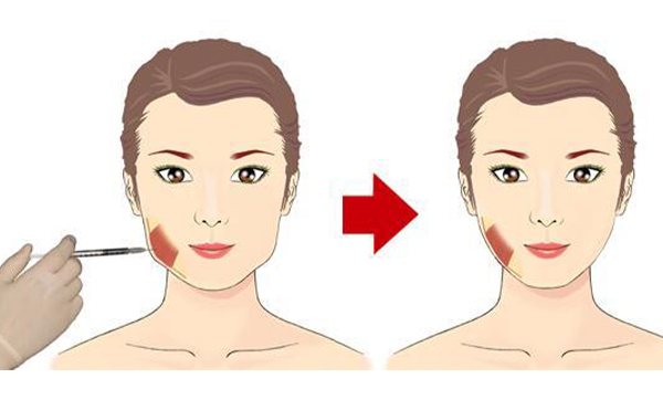 溶脂針、瘦臉針的適宜人群是哪些?