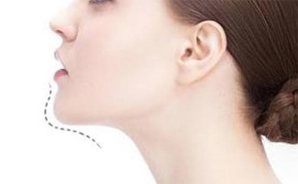 玻尿酸豐下巴好嗎？做玻尿酸豐下巴需要注意什么