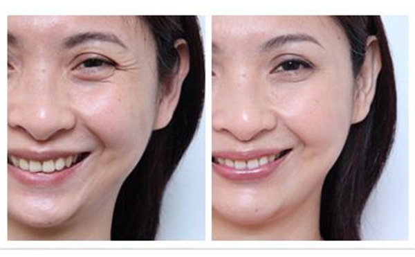 去魚尾紋多少錢？