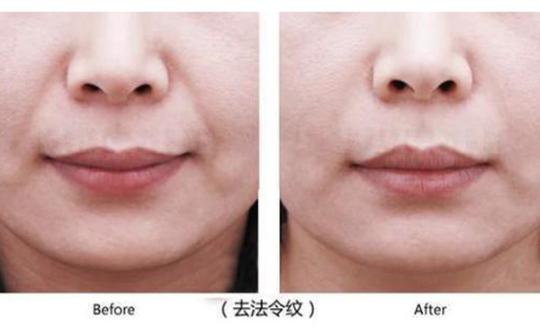 法令紋怎么去除效果好?如何選擇?