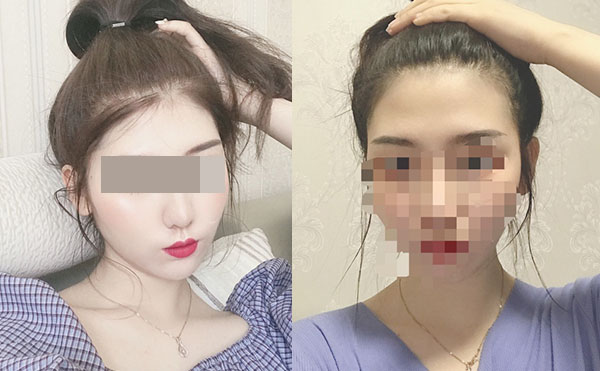 冰點脫毛后多久可以洗澡嗎？