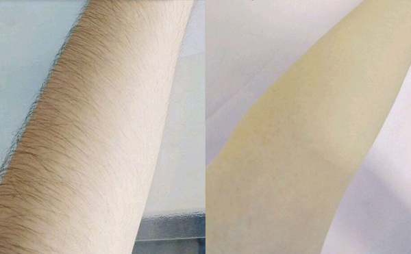 光子脫毛有疼痛感嗎？