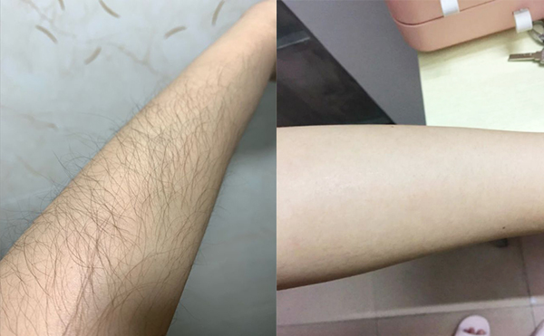 光子手臂脫毛是怎么做的？