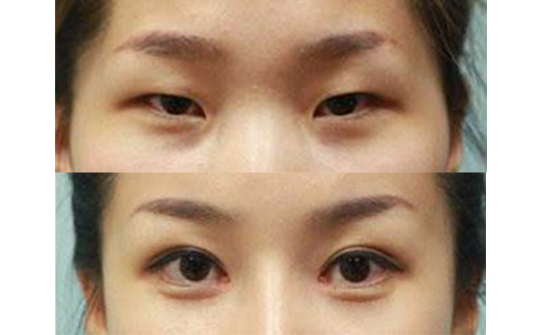 眼綜合手術(shù)多久能恢復(fù)自然？