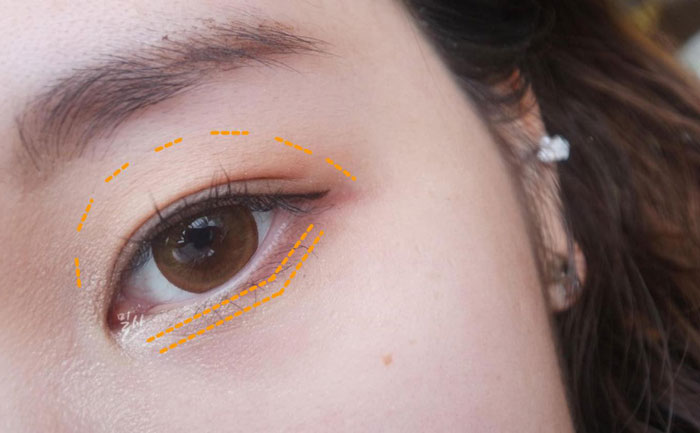 眼窩自體脂肪填充多少錢？自體脂肪豐眼窩成活率高嗎？