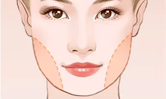 上海藝星做面部吸脂