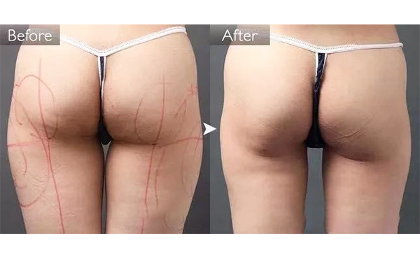 吸脂提臀過程是什么?手術(shù)有什么原則?