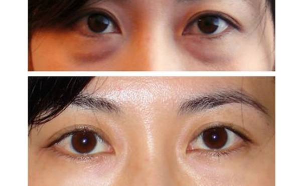 眼袋抽脂的手術(shù)過(guò)程是什么？