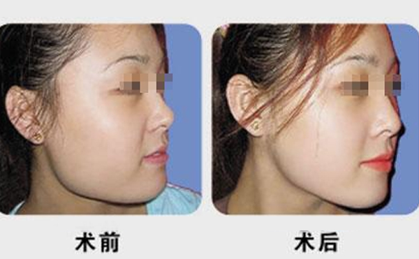 下頜角整形恢復(fù)期是多久?術(shù)前準(zhǔn)備術(shù)后護(hù)理有哪些?