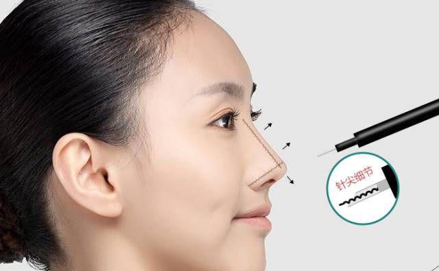 鼻部除皺的最好方法是什么？鼻部除皺多少錢？