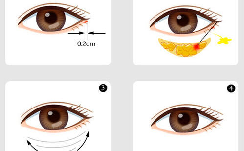 內(nèi)切眼袋怎么做？