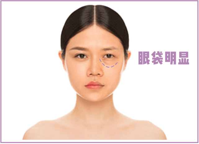 眼袋明顯