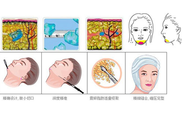 面部吸脂手術(shù)過(guò)程是什么？