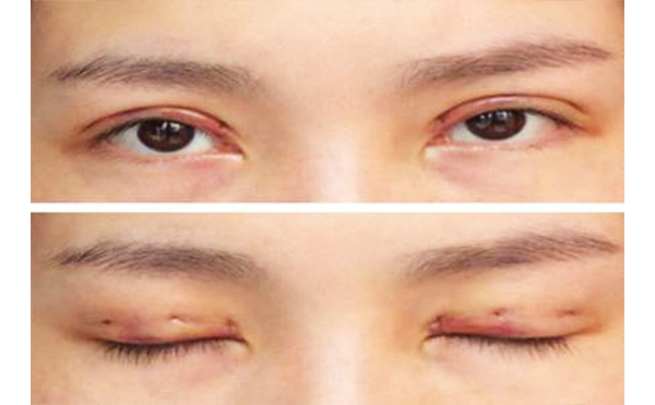 韓式三點(diǎn)雙眼皮是不是永久的?雙眼皮術(shù)后不對(duì)稱怎么辦?