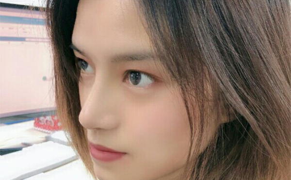 隆鼻術(shù)后一個月