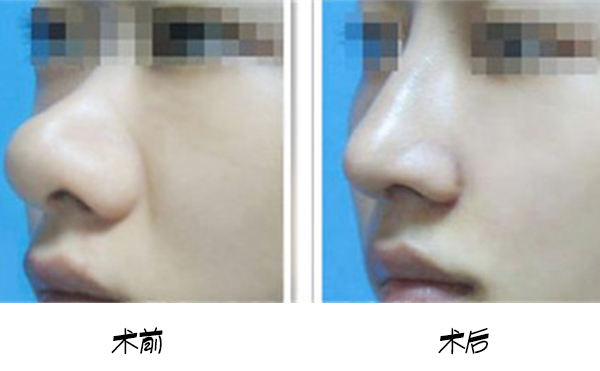 武漢美亞鼻頭肥大矯正術多少錢?網上查到的和醫(yī)院報價一樣嗎?