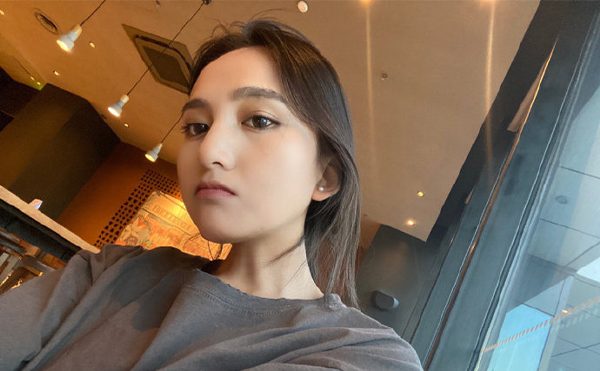 上海首爾麗格樸興植下頜角截骨手術(shù)案例術(shù)后一年