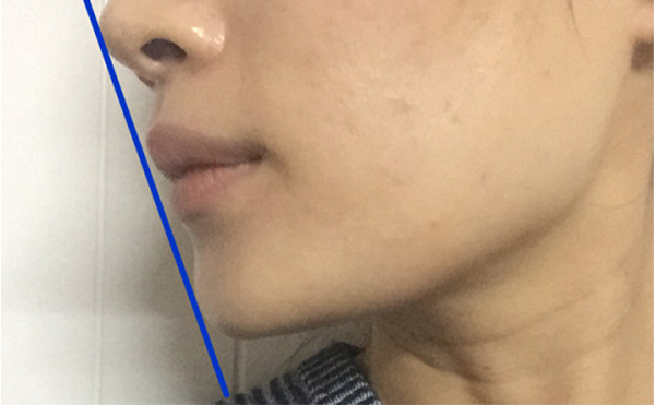 做假體墊下巴恢復后會被摸出來做過嗎？還能打玻尿酸嗎？