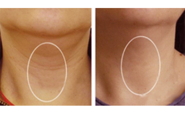 嗨體去頸紋能維持多久？