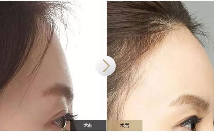 額頭填充術(shù)可以保持多久？