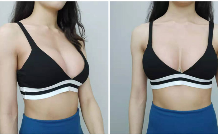 自體豐胸可以保持多久？自體脂肪豐胸真實(shí)效果
