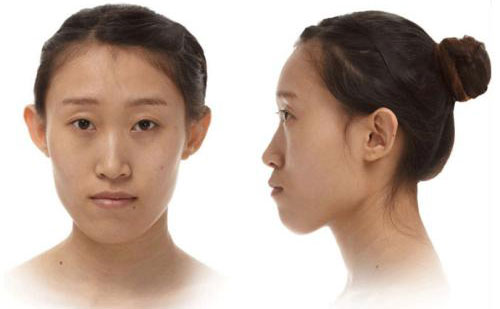 下巴突出是什么原因引起的？下巴突出側面很難看怎么矯正？