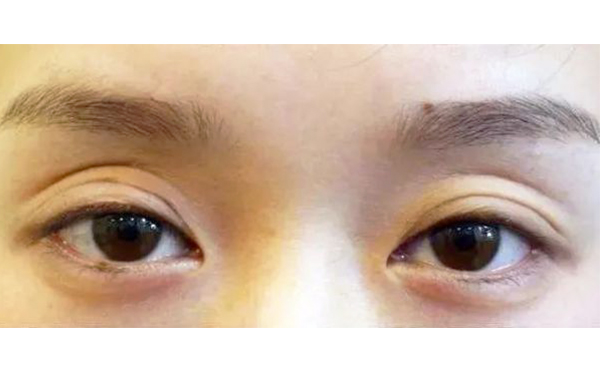上眼皮凹陷怎么恢復飽滿?能維持多久?