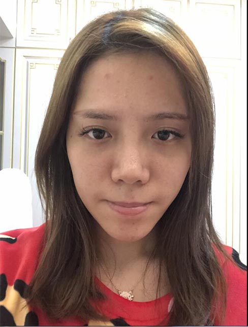 肋軟骨鼻綜合案例：術前效果