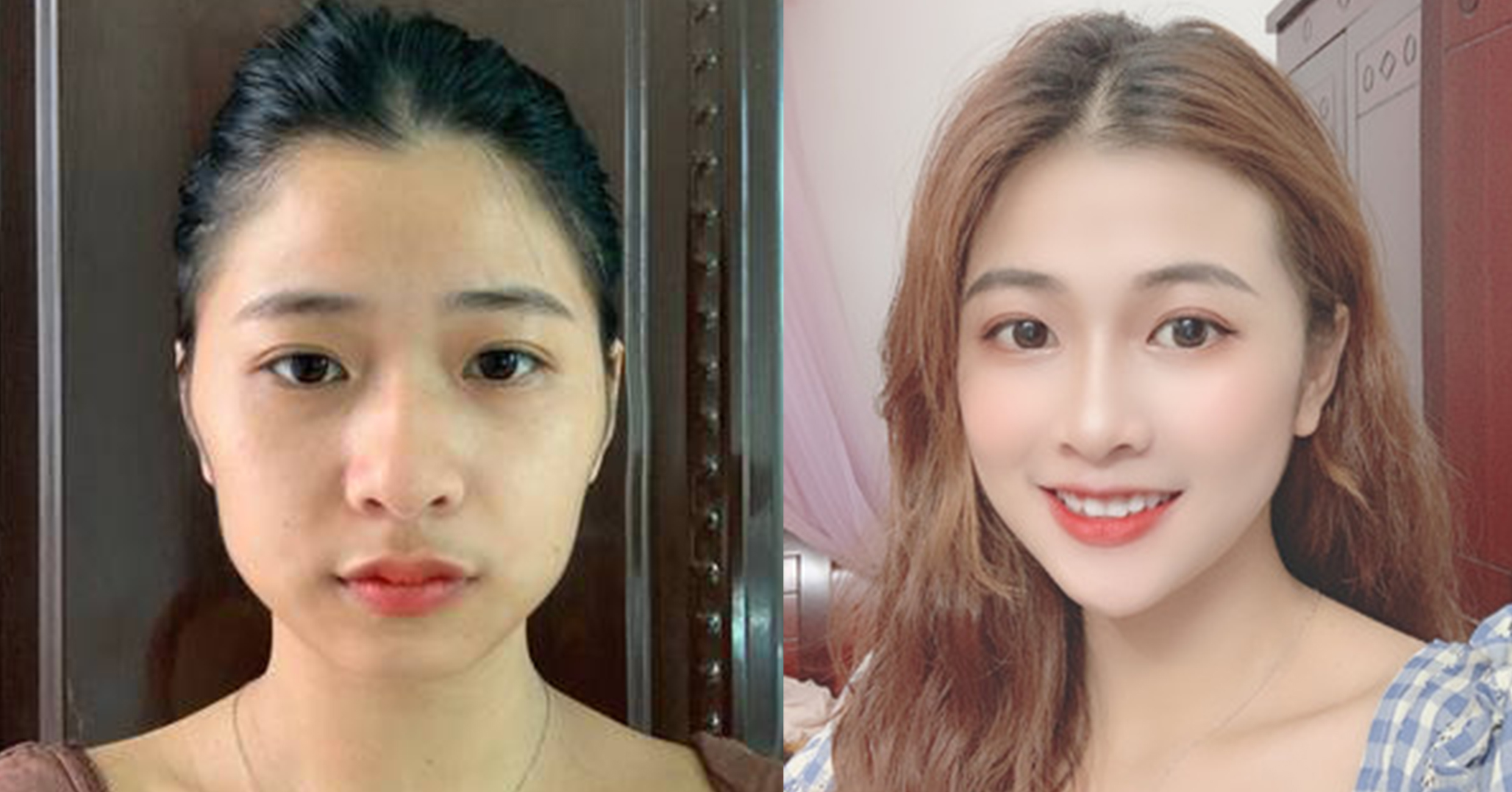 脂肪填充手術(shù)效果對比