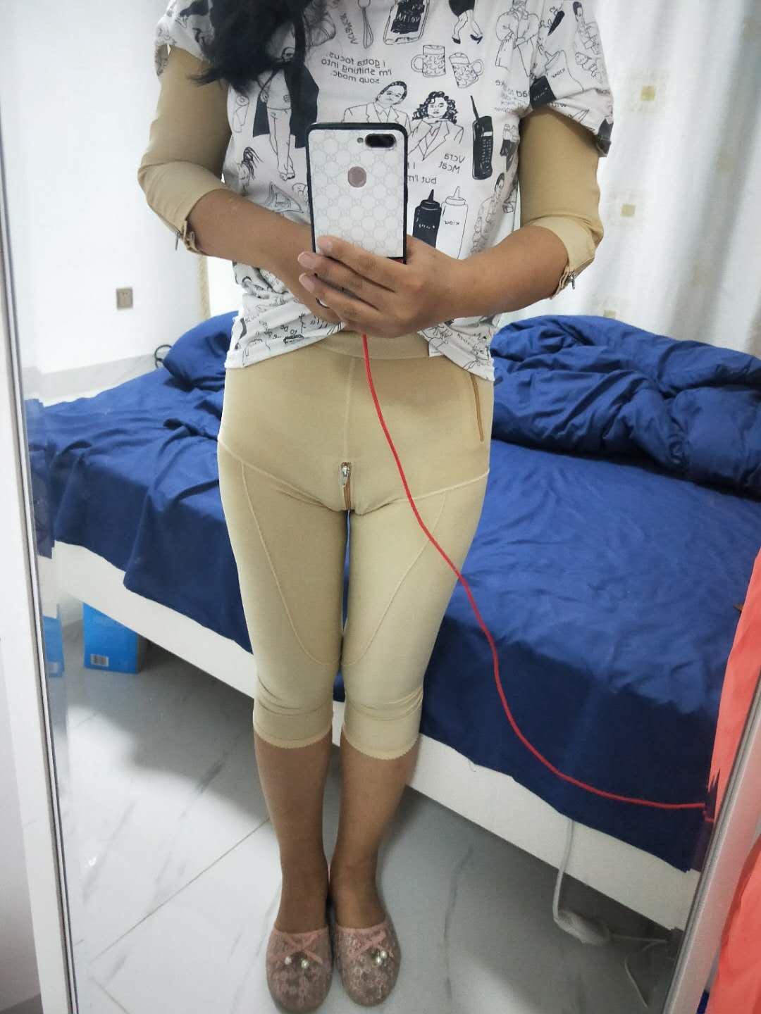 大腿吸脂手術(shù)效果圖3