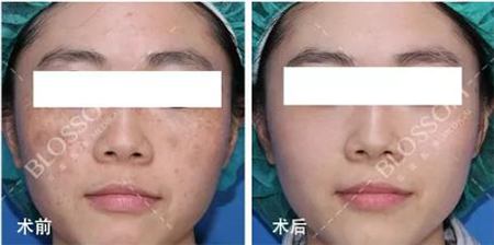 華韓醫(yī)療美容醫(yī)院祛斑案例對(duì)比