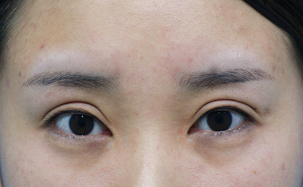 切開雙眼皮手術(shù)做失敗了怎么辦?