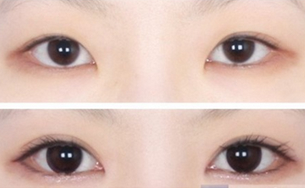 開眼角手術(shù)會不會留下疤痕?術(shù)后有什么注意事項?