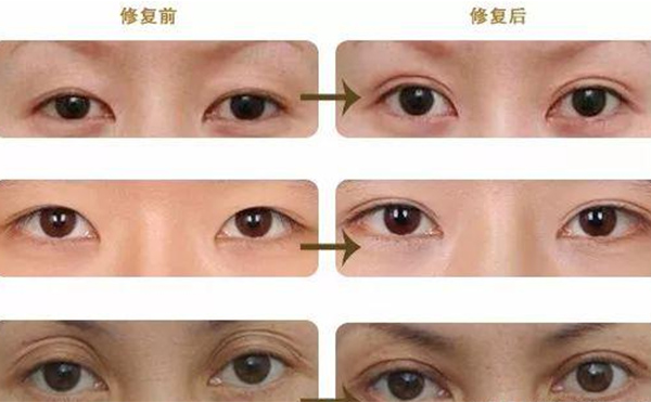 雙眼皮修復(fù)可靠嗎？什么時候做雙眼皮修復(fù)比較好？
