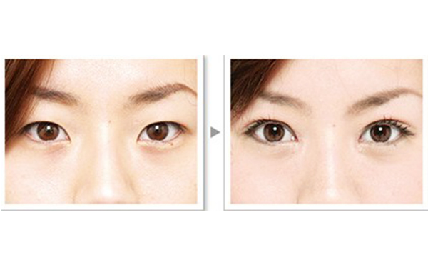 雙眼皮手術(shù)的種類(lèi)及優(yōu)缺點(diǎn)是什么?術(shù)后怎么護(hù)理效果好?